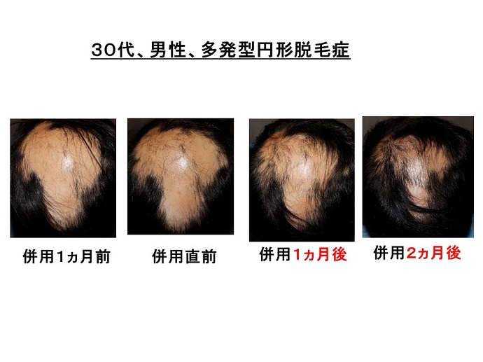 円形脱毛症　病院